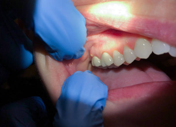 Best Dentist for Tooth Abscess  in Airport, CA